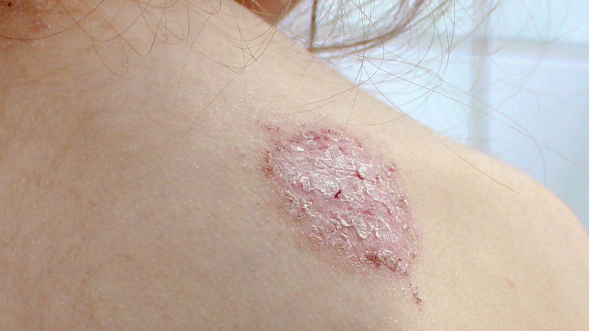 Dermatitis Numularis